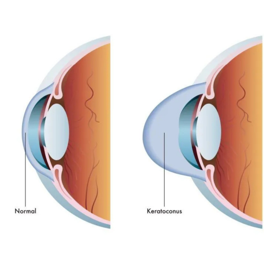 Keratoconus 3